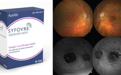 SYFOVRE (pegcetacoplan) recibe aprobación en Australia para el tratamiento de la atrofia geográfica (AG)
