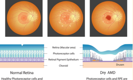 Trasplante de células madre RPESC-RPE-4W recibe designación RMAT de la FDA para tratar la DMAE seca