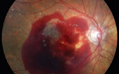 Vivir con DMAE húmeda: una Guía para pacientes y familiares