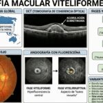 Primer ensayo del mundo para curar la enfermedad de Best, con terapia génica y en EEUU